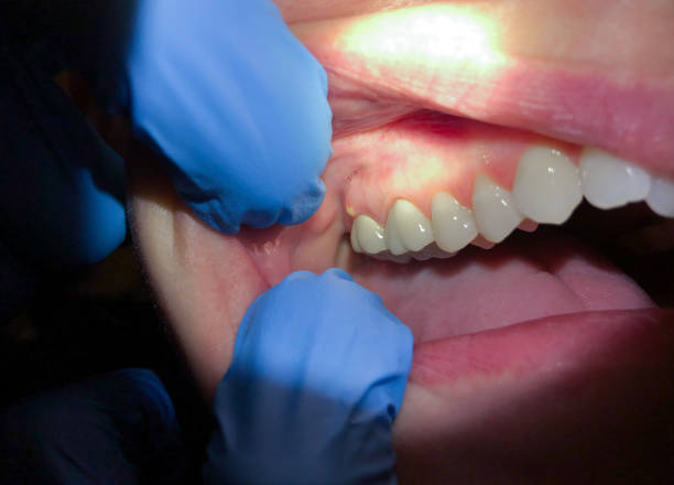 Best Dentist for Tooth Abscess  in Menlo Park, CA