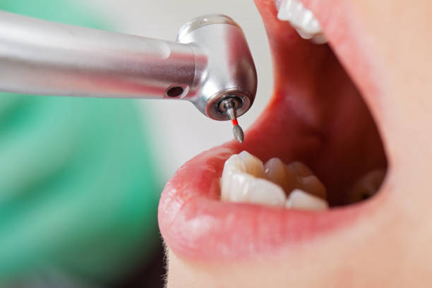 Best Broken Tooth Emergency  in Menlo Park, CA